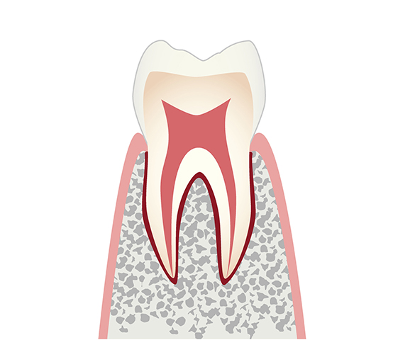 初期虫歯（CO）