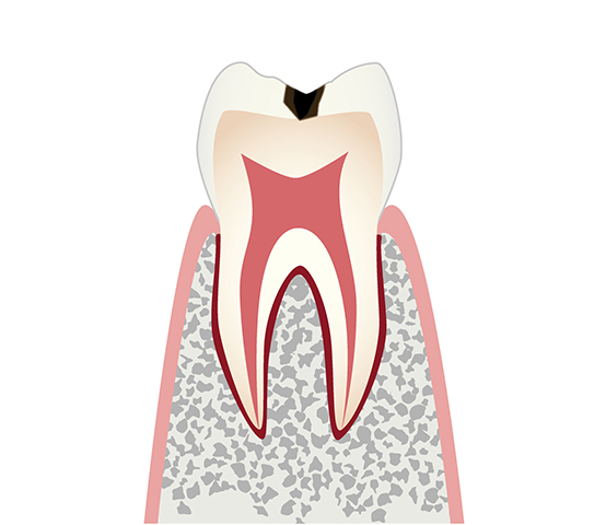 軽度の虫歯（C1）